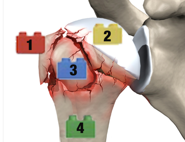 Using Lego Bricks to help orthopaedic surgeons understand different kinds of break of the upper humerus