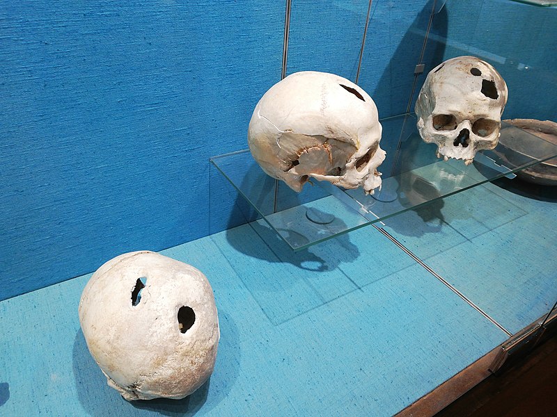 trepanation